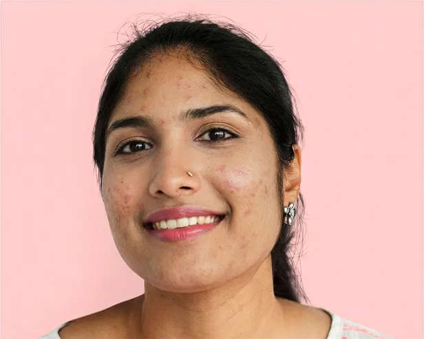 acne treatment kochi before after 1