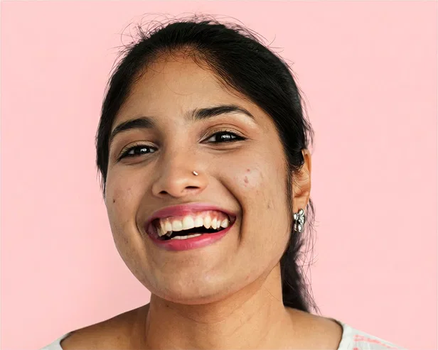 acne treatment kochi before after 2