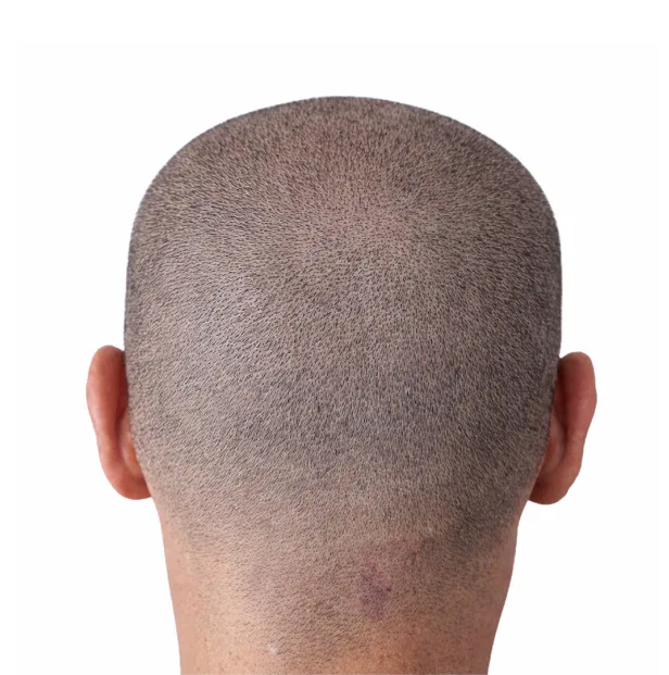 alopecia after treatment
