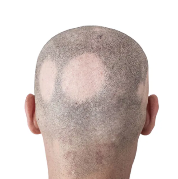 alopecia before treatment