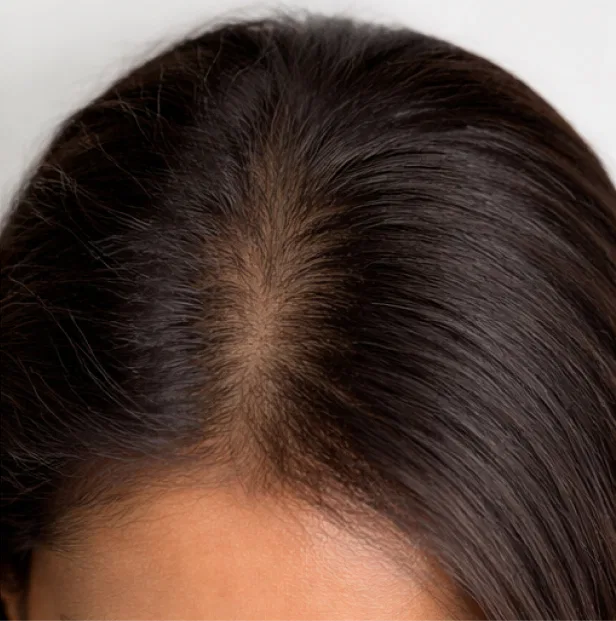 alopecia treatment kochi after