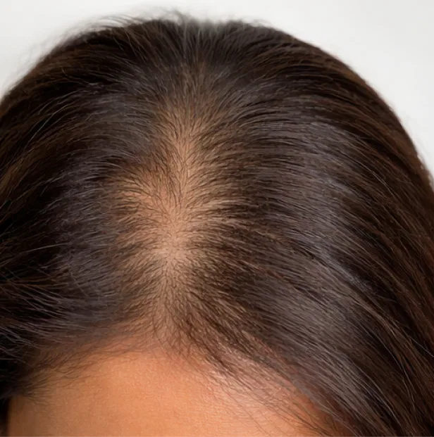 alopecia treatment kochi before