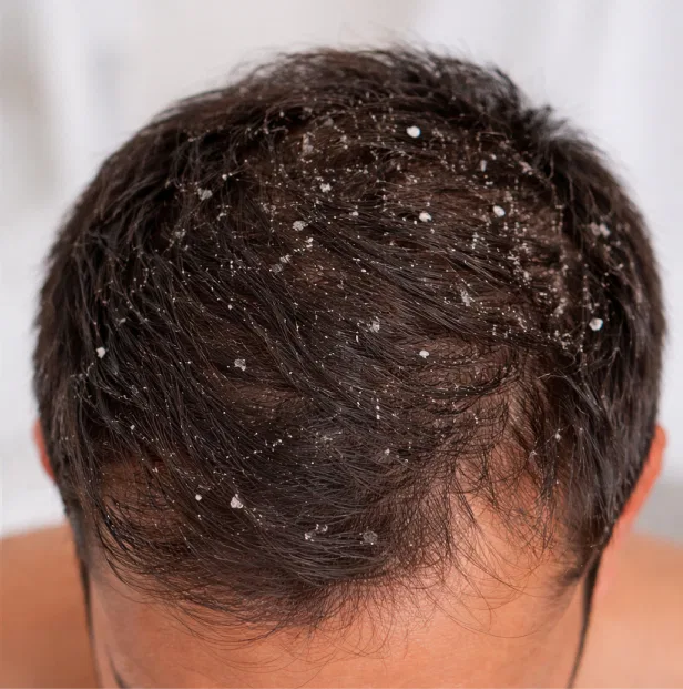 dandruff treatment kichi before