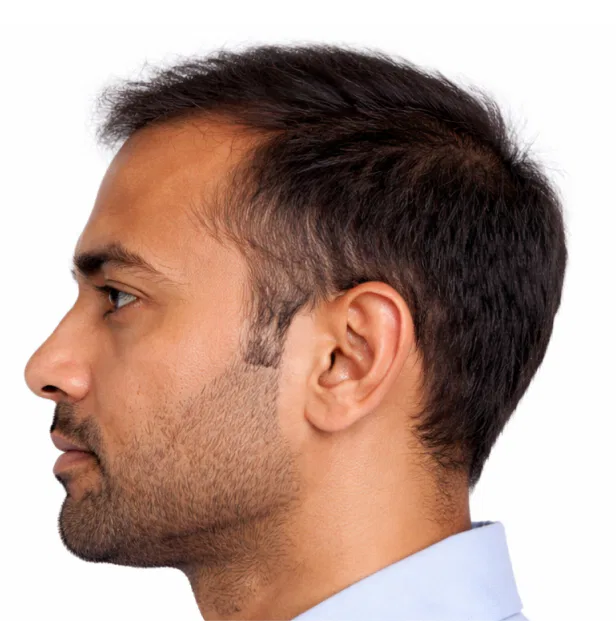 hairloss treatment after