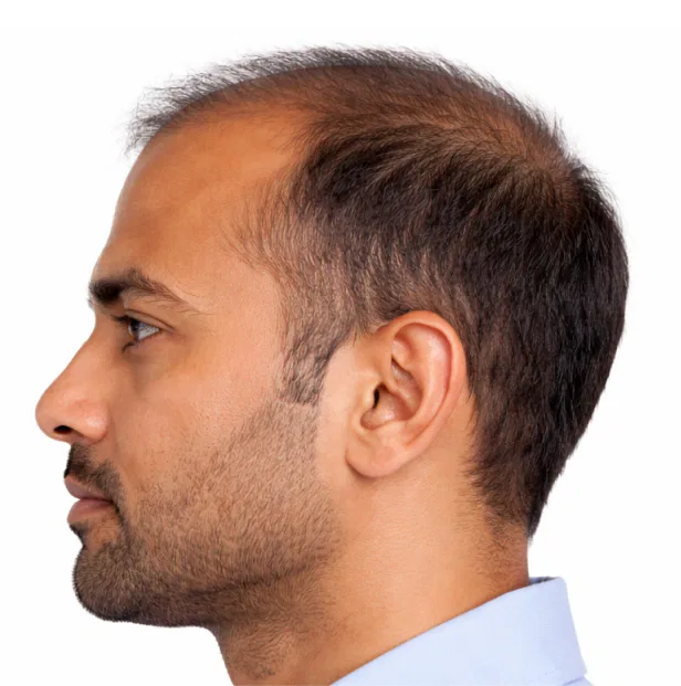 hairloss treatment before