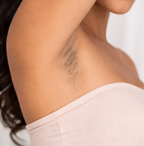 laser hair removal kochi before