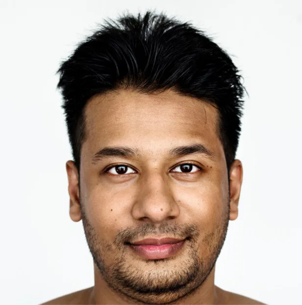 pigmentation after peel