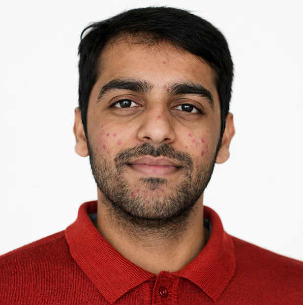 pimple treatment kochi before after