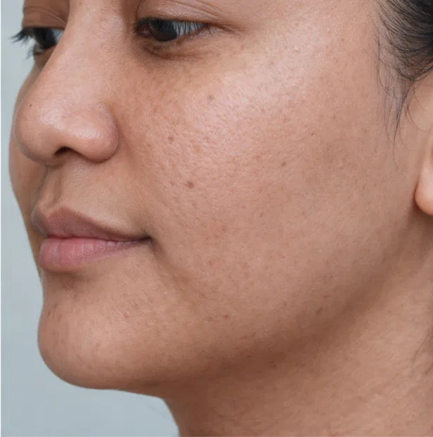 skin growth removal after Kochi