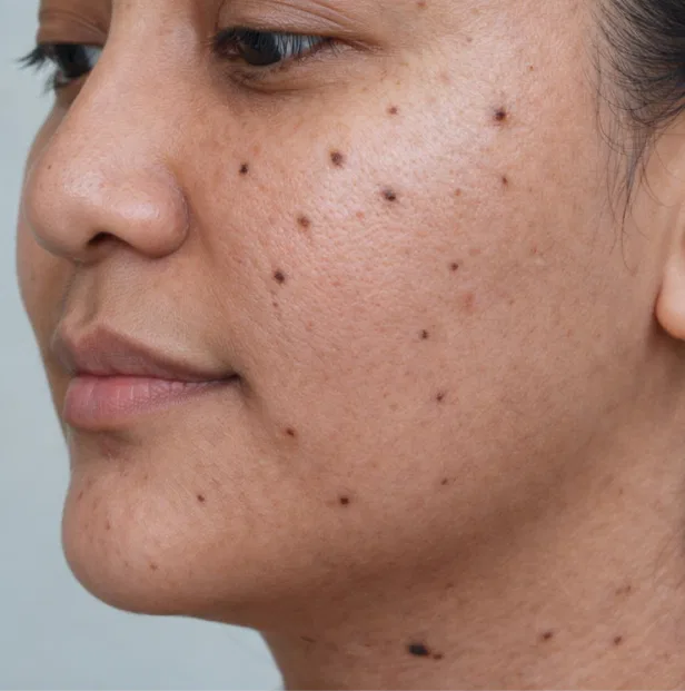 skin growth removal before Kochi