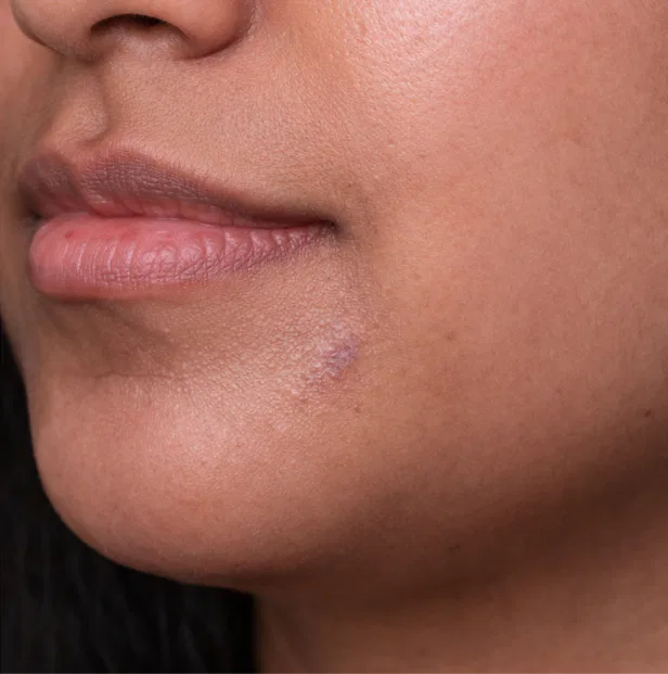 skin tag removal after