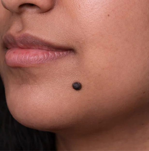 skin tag removal before