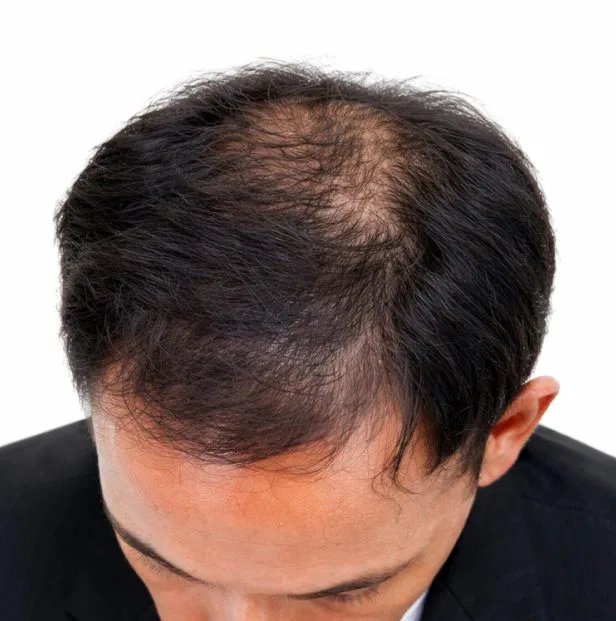 GFC before treatment kochi