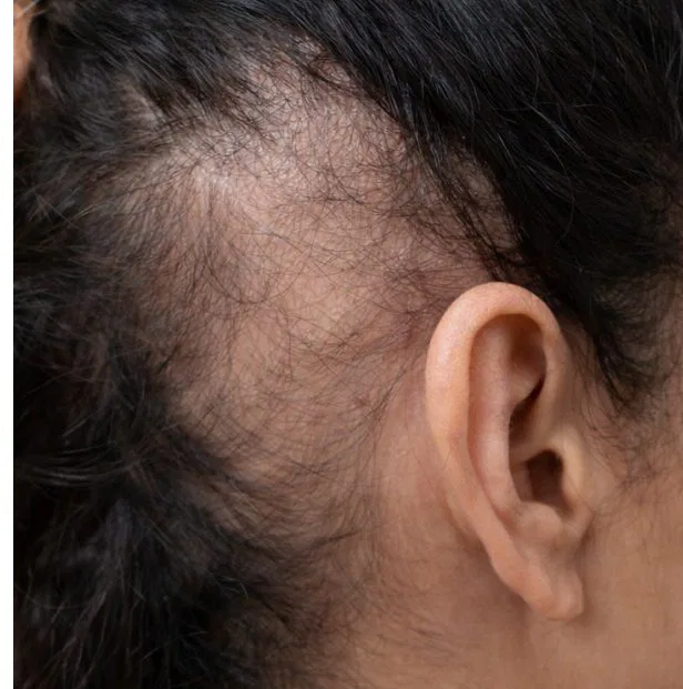 prp hair before results.jpg