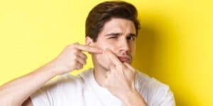 acne scars removal treatment