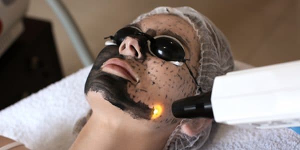 carbon peel in kochi