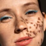 scar treatment that works