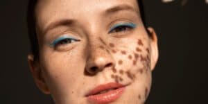 scar treatment that works